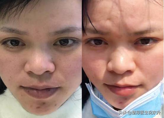 打完水光多久可以涂bb霜,水光针打多了对皮肤有没有副作用