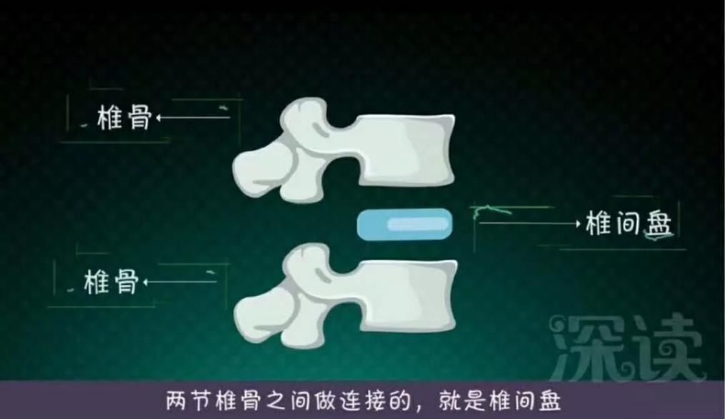 腰间盘突出别发愁记住3个技巧,专家告诉你腰间盘突出该怎么解决