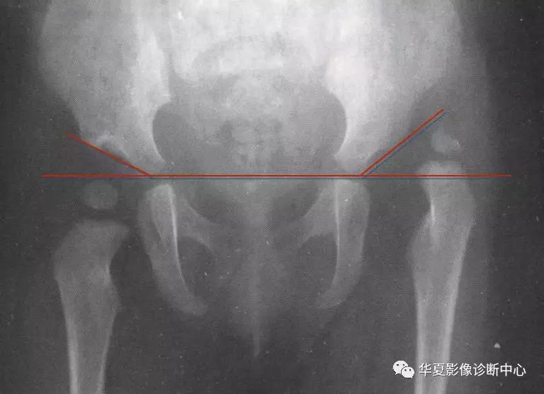 先天性髋关节脱位,先天性髋关节脱位属不属于残疾人