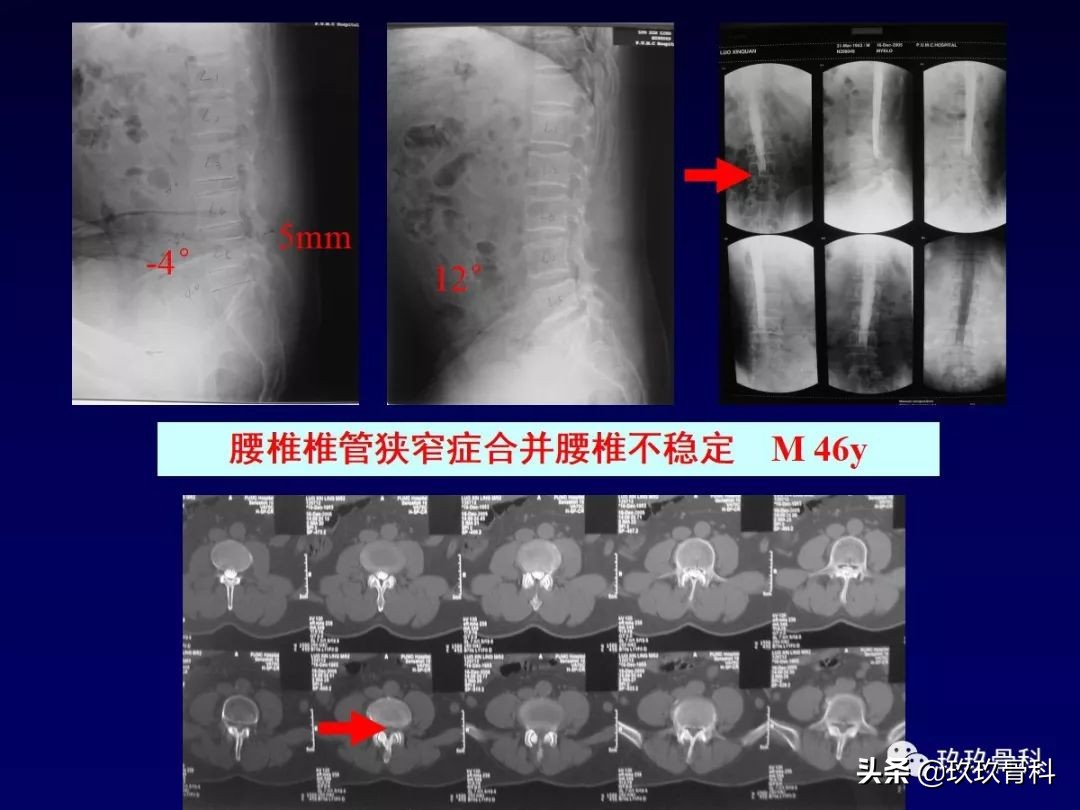 腰椎不稳最坏的结果,腰椎不稳的最佳治疗方法