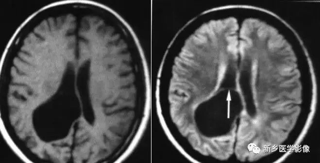 脑室影像学表现,脑室占位影像