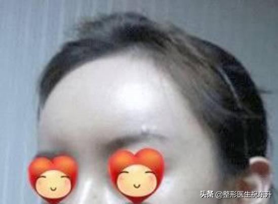 做了额头填充全脸肿怎么办,脂肪填充一年额头填多了怎么办
