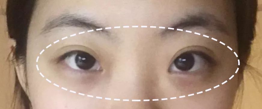 求改善痘痘真实办法,想改变脸上痘痘