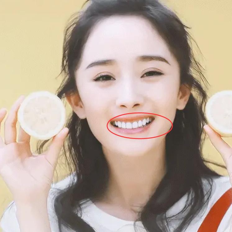 宋茜牙齿是烤瓷牙吗,宋茜做过烤瓷牙吗