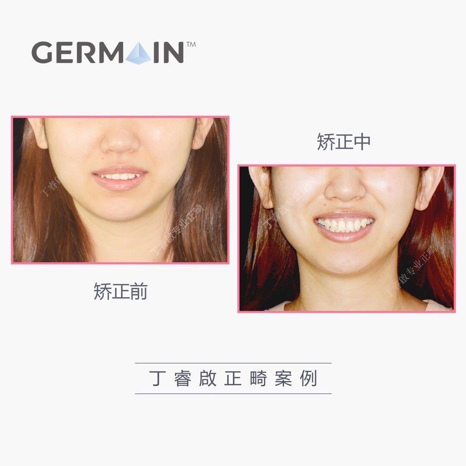 郑州牙齿矫正丁睿啟|下巴后缩病例合集