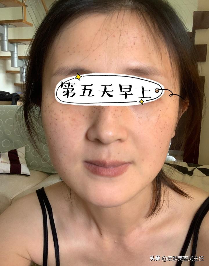 蜂巢皮秒英诺小棕瓶,脸上有斑的可以用英诺小棕瓶吗