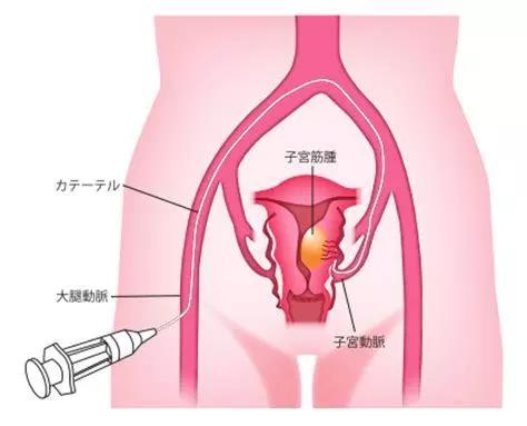 子宫肌瘤的10个前兆,子宫肌瘤有八个注意事项