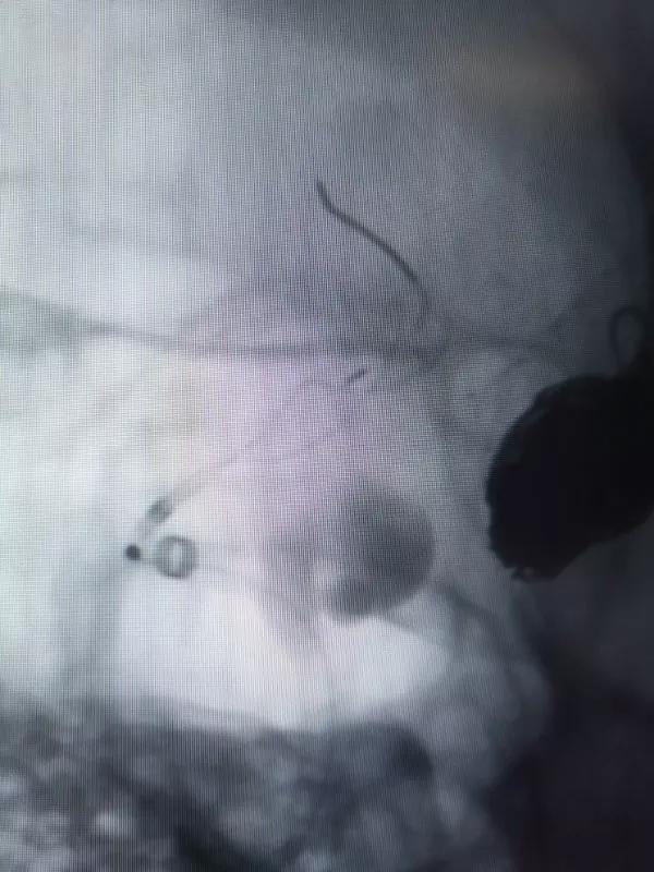 山东大学齐鲁医院王东海教授团队成功治疗多发性动脉瘤