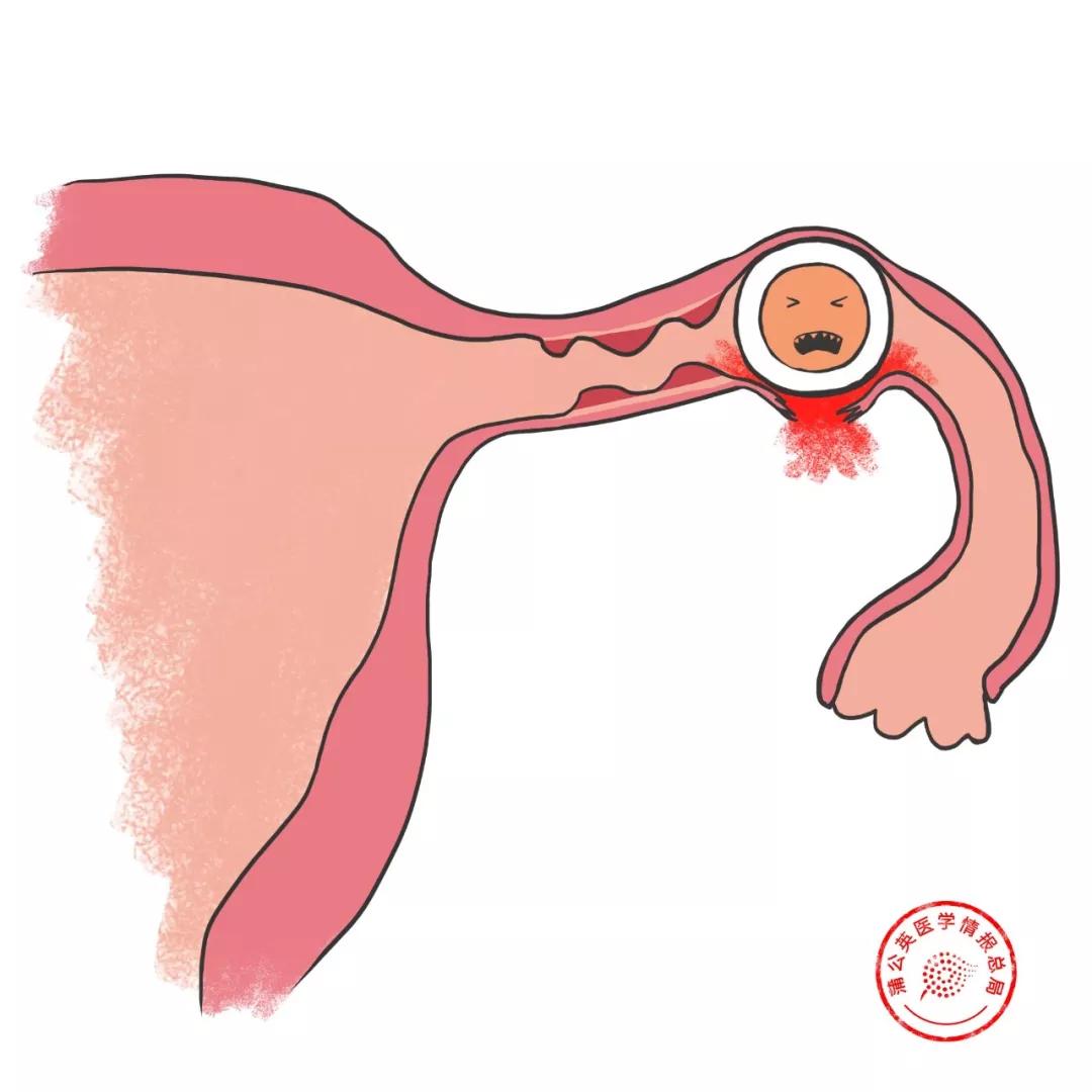 宫外孕输卵管切除一边容易怀孕吗,宫外孕有得治吗
