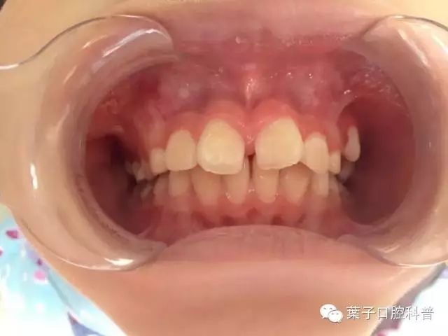 孩子多余的牙齿什么年龄适合拔掉,小孩子的牙齿需要填补吗