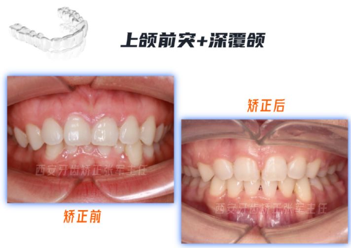 牙齿矫正雁塔区,矫正牙齿拔掉4颗智齿