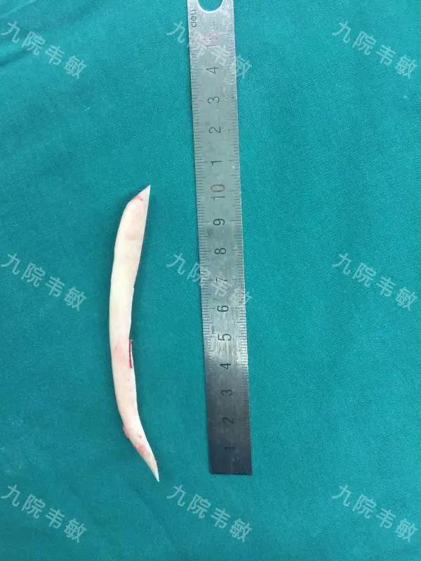 不想做正颌手术怎么改善嘴突,脸不对称挂号正畸还是正颌