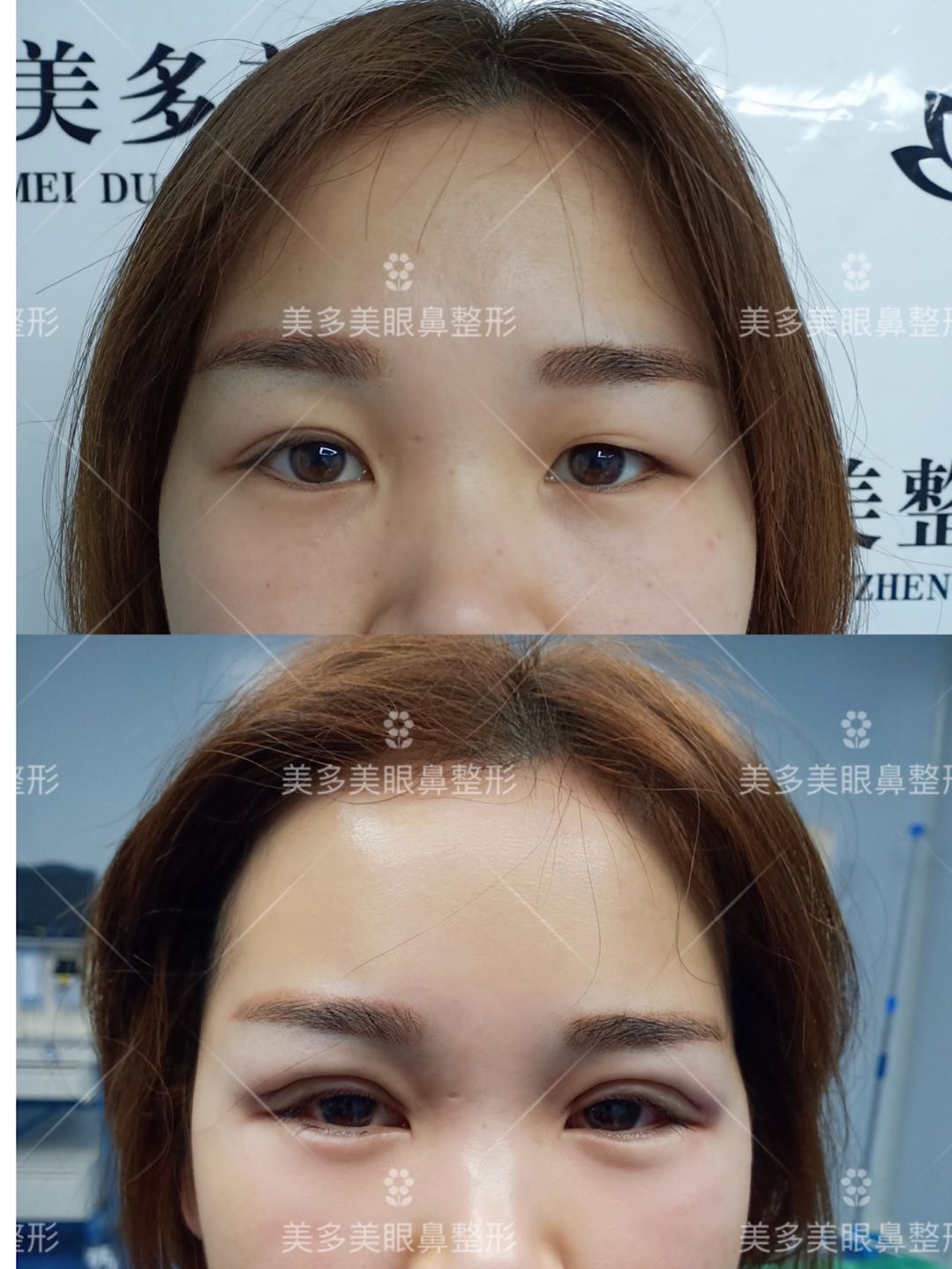 双眼皮手术睁眼闭眼效果,双眼皮手术怎么看着不假