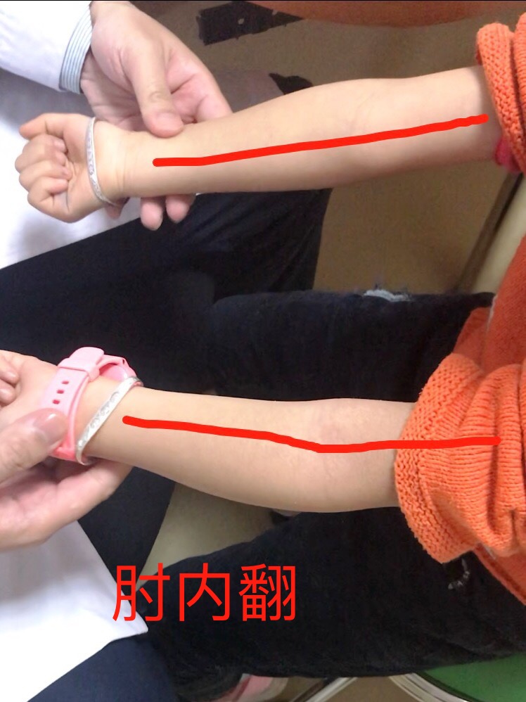 手臂骨折出现畸形愈合怎么处理,手臂骨折复位不正怎么补救