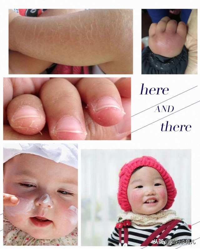 宝宝皮肤干燥起皮脱屑如何呵护,冬天宝宝干燥起皮怎么办