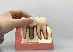 缺牙真的伤不起,缺牙对你最大的影响