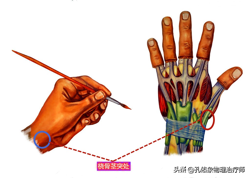 中年人患腱鞘炎怎么治,中老年腱鞘炎特效药