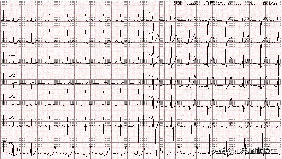 心电图一二三代表什么,心电图一二三导联示意图