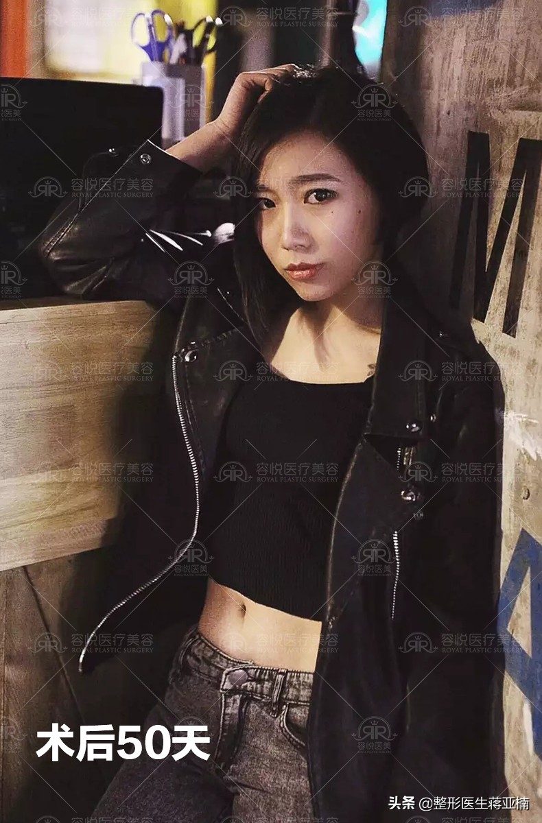 全身吸脂18斤需要多少钱,8000的面部吸脂