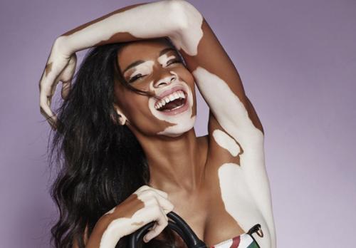 白癜风辅助疗法,如虎添翼与锦上添花