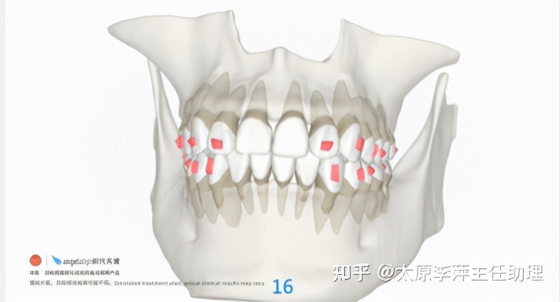 太原牙齿矫正靠谱吗,太原成人隐形牙套牙齿不齐