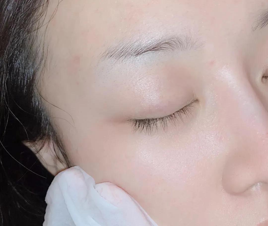 祛鼻头黑头最有效的方法,怎样祛黑头最有效的方法