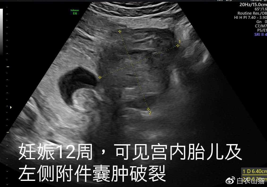 双胞胎，一个在宫内，一个躲宫外。孕妈生命垂危，医生妙手回春！