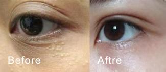 脂肪粒怎么用针挑出的,脂肪粒多久可以用针挑出来