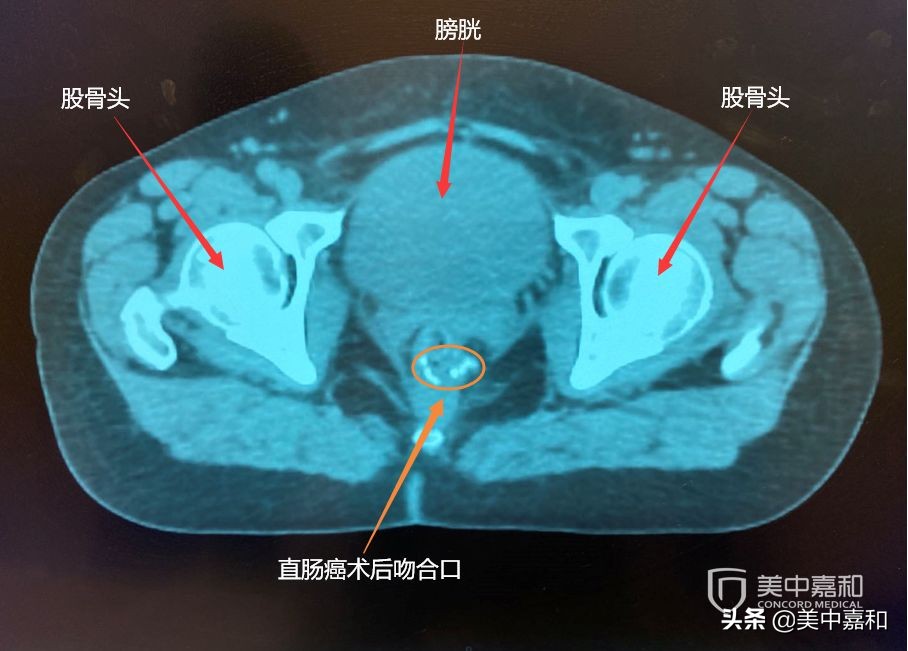 癌症术后3年不复发是个大坎,癌症术后复发取决于什么原因
