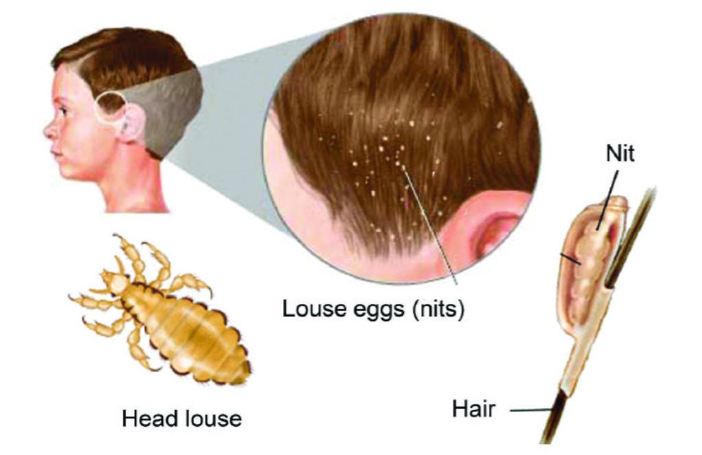 30年前每个人身上都有虱子,30年前人人都有的虱子为什么不见