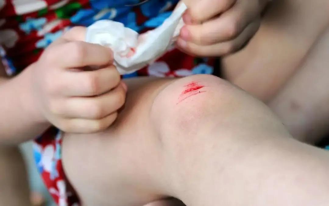 儿童受伤涂碘伏的视频,孩子受伤结痂可以用红霉素软膏吗