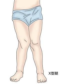 膝外翻超过15度怎么办,膝内翻或膝外翻的原因