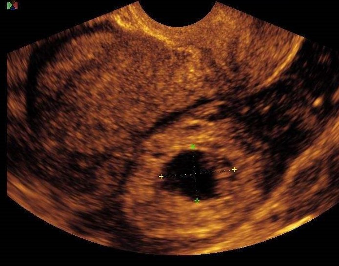 同居女友腹痛12小时死亡，宫外孕到底多可怕？7类孕妇容易宫外孕