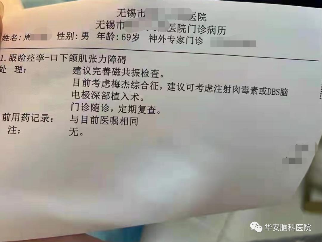 梅杰综合征dbs手术需要开颅吗,梅杰dbs手术住院需要几天