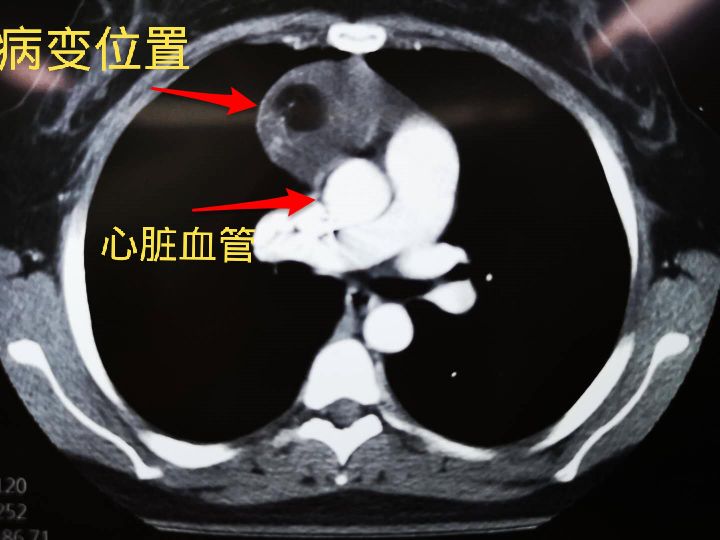 胸口疼发现了一个肿瘤严重吗,胸口疼去检查发现有一个瘤子