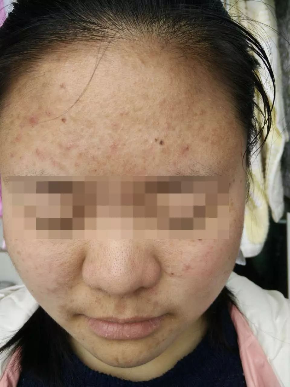 毛囊炎要不要清痘,脸毛囊炎和痘痘的区别