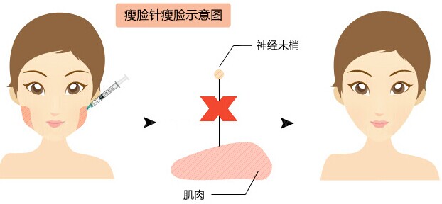 注射瘦脸术好不好,注射肉毒素瘦脸维持多久