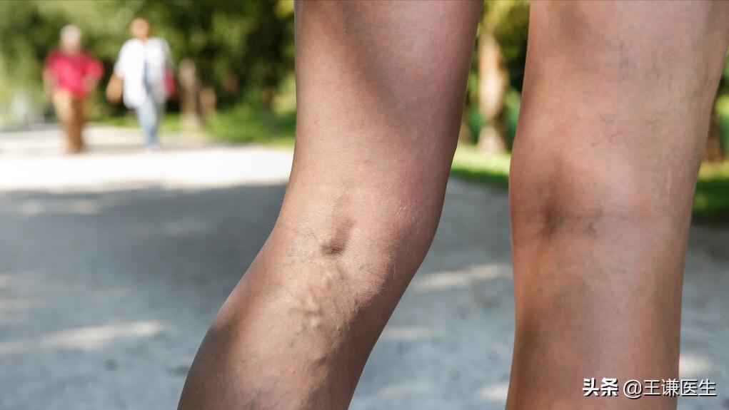 治静脉曲张的弹力袜选几级,静脉曲张弹力袜怎么挑选