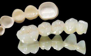 全瓷牙和烤瓷牙的区别到底在哪,全瓷牙与普通烤瓷牙的区别是什么