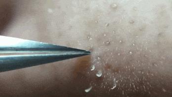 毛孔堵塞有黄色油脂,毛孔长黄色油脂粒