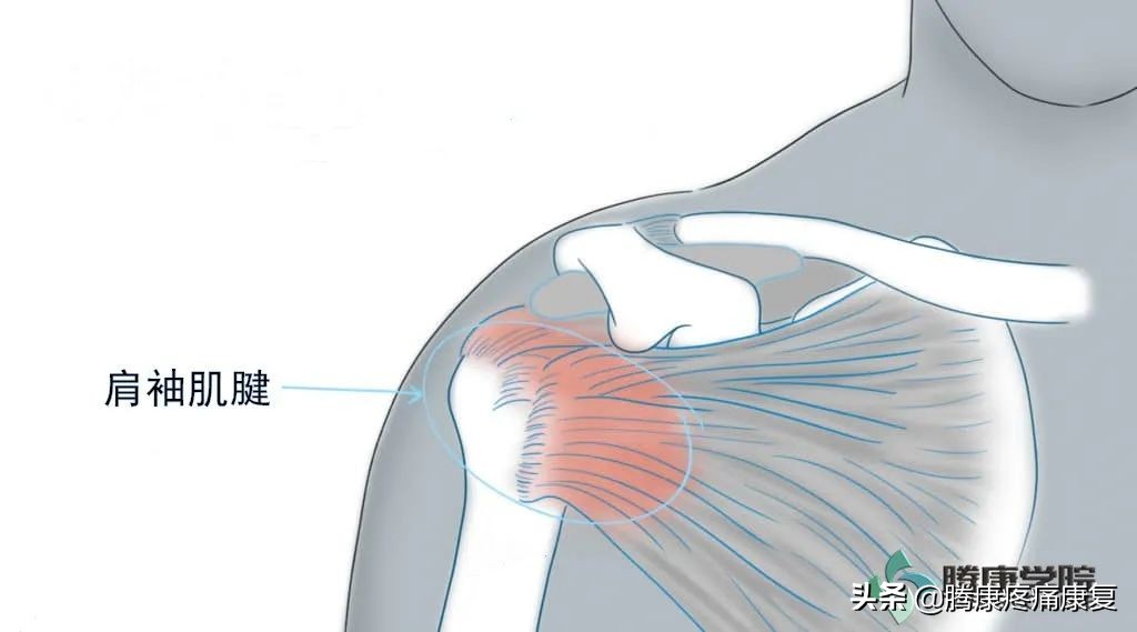 肩关节急性钙化性肌腱炎