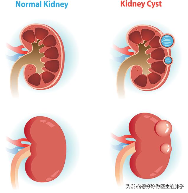 辟谣囊肿手术,如果囊肿是良性的话要不要做手术
