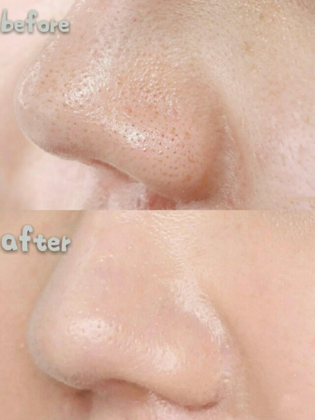 芭贝拉收缩毛孔鼻贴,黑头鼻贴收缩毛孔男