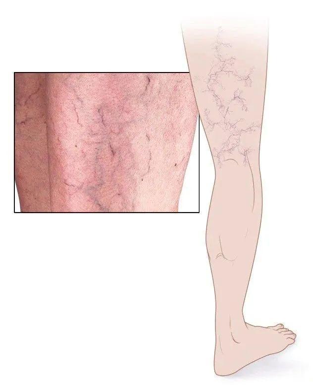 静脉曲张是什么？静脉曲张怎么预防？如何改善静脉曲张？