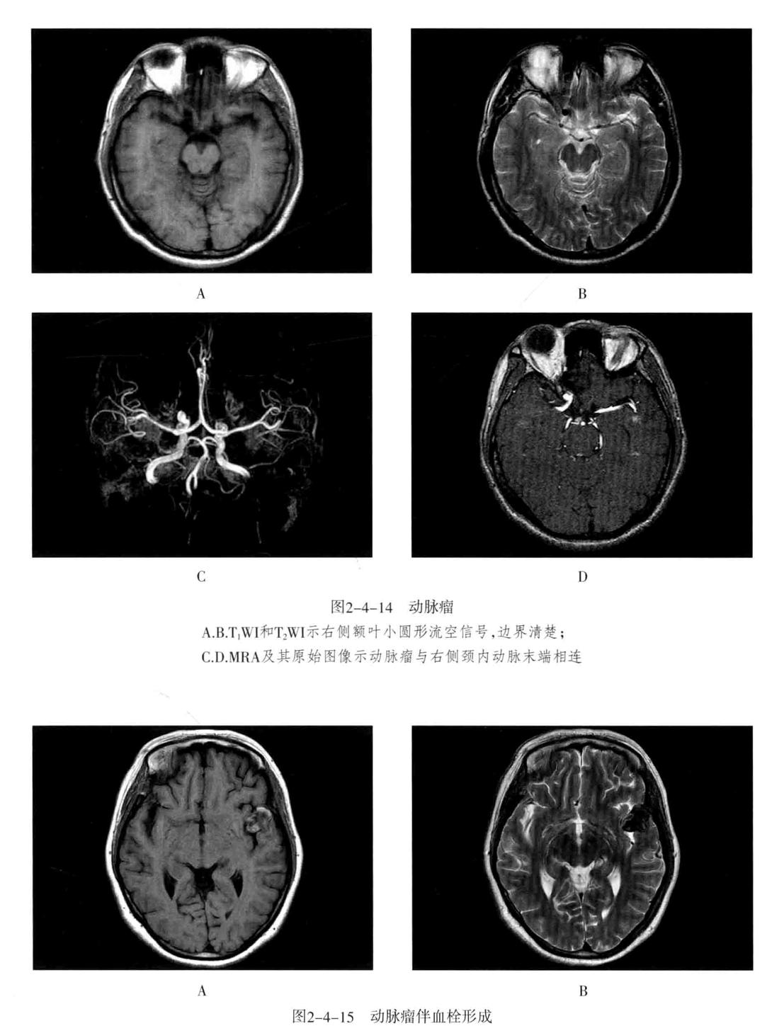 颅内血管周围间隙的影像鉴别,颅脑血管源性疾病影像诊断