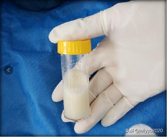 全麻支气管镜肺泡灌洗过程,支气管镜肺泡灌洗术一般做几次