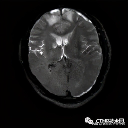 「MRI技术」磁共振伪影分析,了解下SSh_FLAIR序列