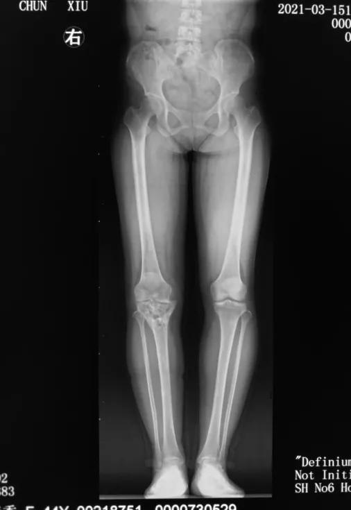 「病例精选」不用换关节，TCVO手术给您新“膝”望