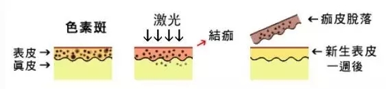 雀斑晒斑的形成原因及如何改善,色斑雀斑晒斑的图片