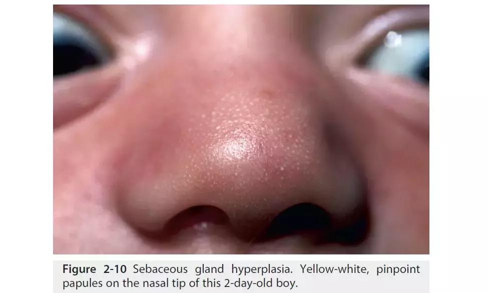 新生儿皮肤问题大全一览表,新生儿常见八大皮肤问题